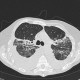 Atypical pneumonia, subacute stage, lung fibrosis: CT - Computed tomography